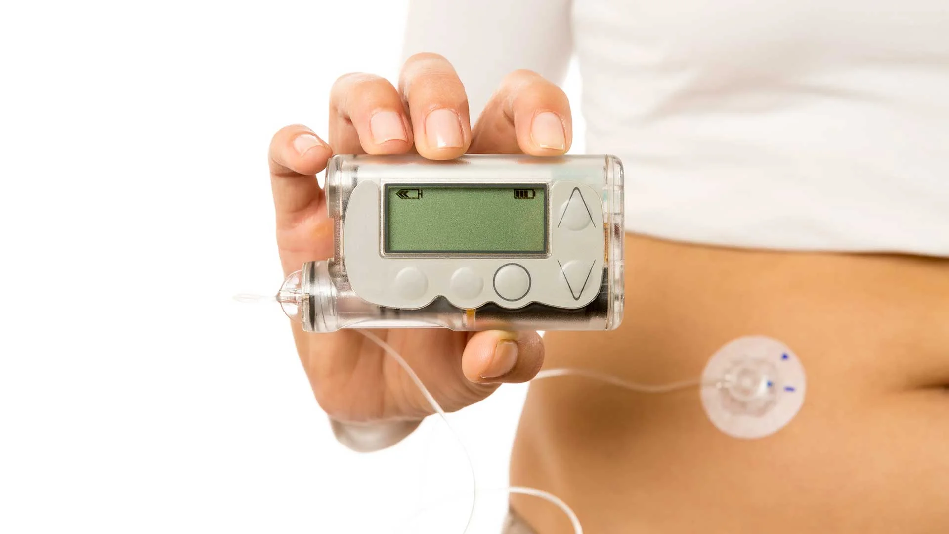 infusion site for insulin pump with tubing. This pictures shows an