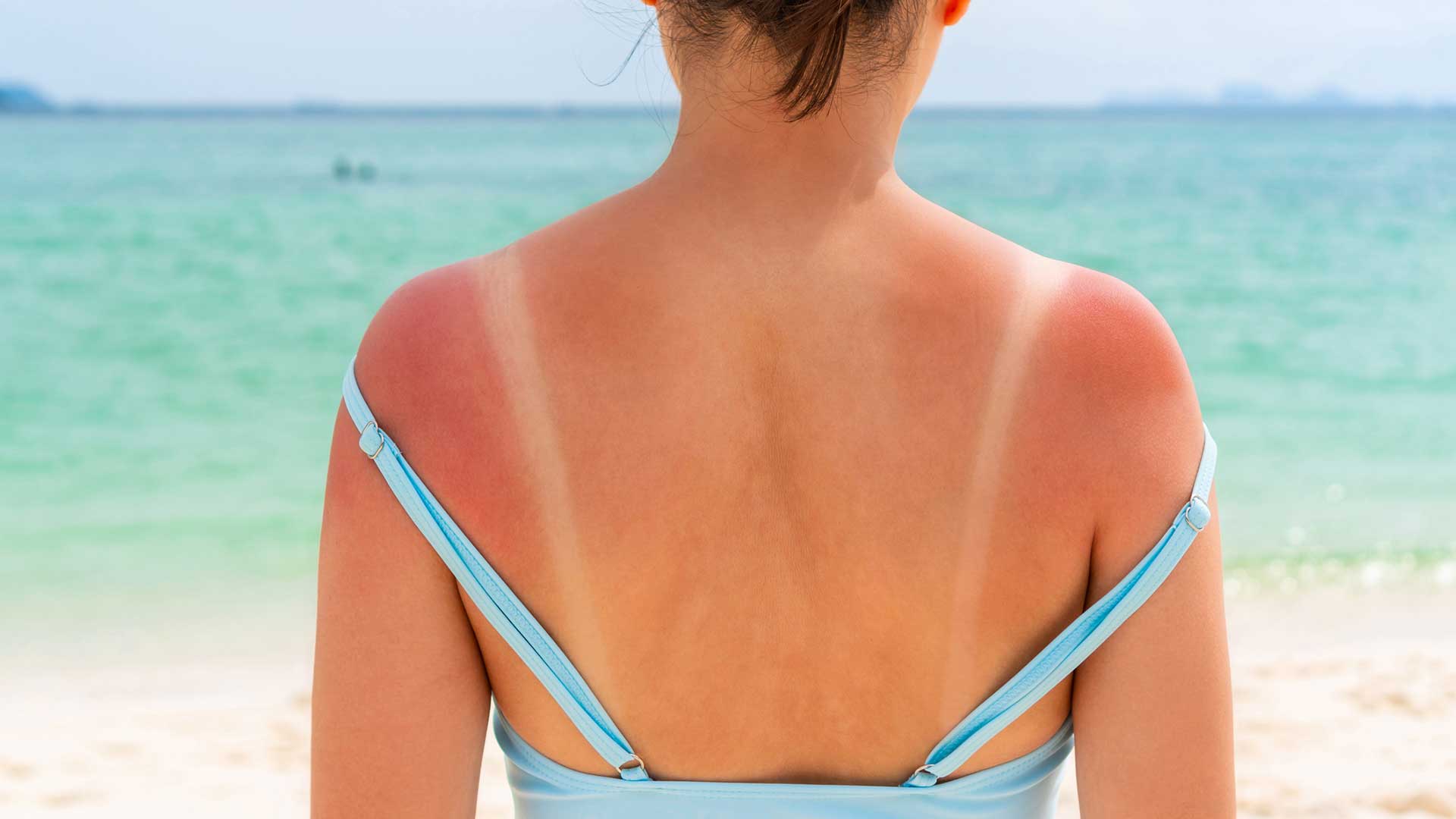Why you should avoid sunburns if you have T1D - Gluroo
